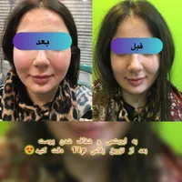 لیزر، مو و زیبایی
