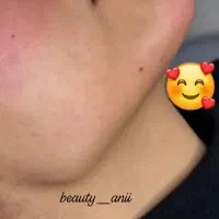 جشنواره ژل لب روسی و بوتاکس|خدمات آرایشگری و زیبایی|فردیس, شهرک ارم|دیوار