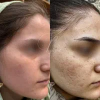 مدل جهت کار درمان تلفیقی پوست|خدمات آرایشگری و زیبایی|چالوس, |دیوار