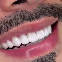 عصبکشی روکش کامپوزیت دندانپزشکی شهرک چیتگر آزادی