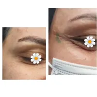 آف بوتاکس و میکرونیدلینگ جای جوش و آموزش