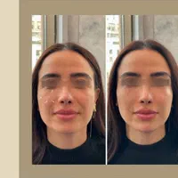 لیزر موهای زائد با قیمت باور نکردنی 550 فول بادی