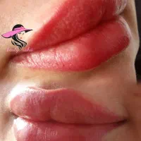 تزریق ژل و بوتاکس