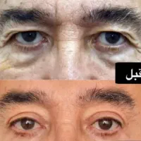 جراحی بینی لیفت بوتاکس نخ مزو فیلر فشیال|خدمات آرایشگری و زیبایی|شاهین‌شهر, عطار|دیوار