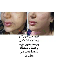 جوانسازی قوی بدون مواد