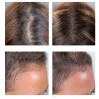 مزوتراپی مو (قطع ریزش)|خدمات آرایشگری و زیبایی|اندیشه, اندیشه فاز ۳|دیوار