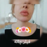 بوتاکس. فیلر. مزوتراپی. فشیال|خدمات آرایشگری و زیبایی|تهران, زاهد گیلانی|دیوار