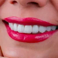 کامپوزیت دندان لمینت روکش دندانپزشکی نامبروان|خدمات زیبایی و سلامت|تهران, نارمک جنوبی|دیوار