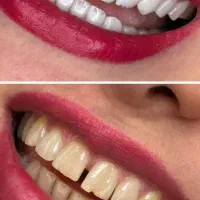 خدمات دندانپزشکی - ایمپلنت - کامپوزیت دندان