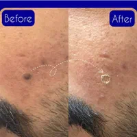 خال برداری و ضایعات پوستی در کلینیک معتبر|خدمات آرایشگری و زیبایی|کرمانشاه, |دیوار