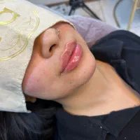 بوتاکس لیزر ریمو تتو ژل جوانساز لاغری فیشال لک