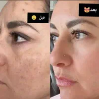 بیوممتیک بزن چروکاتو نابود کن