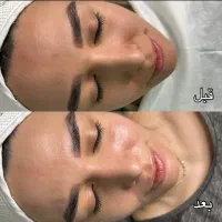 پاکسازی تخصصی پوست تضمینی