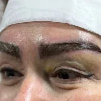 کاشت ابرو به روش سوپر نچرال