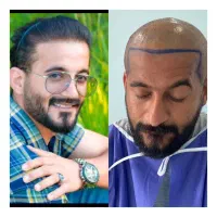 کاشت مو،ریش ،سیبیل،ابرو،پی آرپی ومزوتراپی