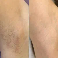 رفع دائم موهای زائد