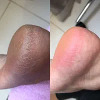 پدیکور تخصصی پا