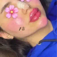 ژل لب چونه گونه زاویه فک و بوتاکس ۳۹۹ تا آخر هفته