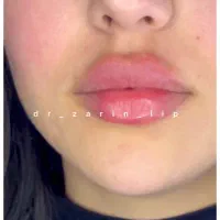 کلینیک تخصصی تزریق فیلر/ژل لب روسی/مادلینگ نچرال|خدمات آرایشگری و زیبایی|تهران, الهیه|دیوار