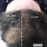 میکرواسکالپ سر|خدمات آرایشگری و زیبایی|جهرم, |دیوار