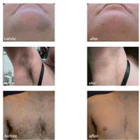 لیزر فول بادی بدون درد با سری شخصی|خدمات آرایشگری و زیبایی|مشهد, موسوی قوچانی|دیوار