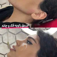 فقط امروز تزریق ژل با تخفیف عالی|خدمات آرایشگری و زیبایی|آبیک, |دیوار