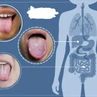 تشخیصبیماری ها از روی زبان به وسیله طب سنتی