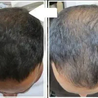 جشنواره درمان قطعی ریزش مو با پی آر پی(prp)