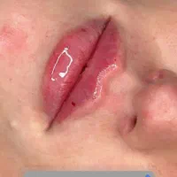تزریق فیلر بوتاکس فیشال درمان لک جوش چین و چروک|خدمات آرایشگری و زیبایی|محمدشهر, محمدشهر|دیوار