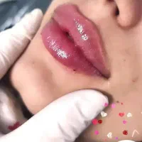 جشنواره تزریق فیلر و بوتاکس گوهردشت