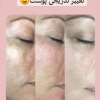 مزو تراپی و کربوکسی تراپی