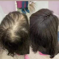 معجزه  رویش مو فقط در 30 روز