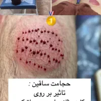 حجامت رفع مشکلات کبدی تیرگی پوست خستگی و غلظت خون