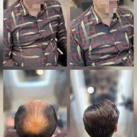 پروتز موی طبیعی و حرفه ای ویژه آقایان و بانوان|خدمات آرایشگری و زیبایی|کرمانشاه, |دیوار