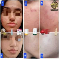 پاکسازی و فیشال ۵۰٪ تخفیف«مشاوره رایگان، خ بزرگمهر|خدمات آرایشگری و زیبایی|اصفهان, چشمه باقرخان|دیوار