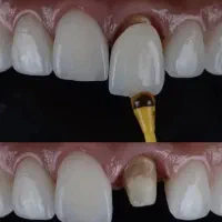 خدمات دندانپزشکی(روکش و کامپوزیت‌و..)