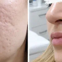 رفع اسکار تخصصی