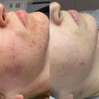 پاکسازی تخصصی پوست در شاهینشهر