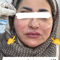 بوتاکس خطوط پیشانی و اخم رایگان‌ شد|خدمات آرایشگری و زیبایی|قم, هفت تیر|دیوار