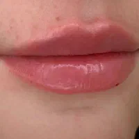 اموزش وخدمات ژل بوتاکس انزیم