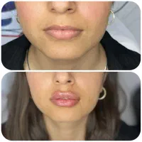 لیزر، ژل،بوتاکس،خال برداری و الکترولیز،پی ار پیprp
