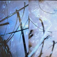 اسکالپ تریتمنت اسکراپ سر