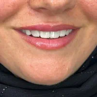 ایمپلنت اقساطی لردگان