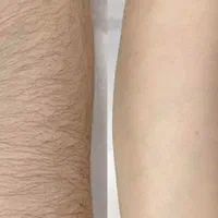 لیزر موهای زائد بانوان فول بادی  فقط ۲۹۹ مدت محدود|خدمات آرایشگری و زیبایی|تبریز, |دیوار