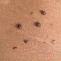 برداشتن خال زگیل گوشت اضاف برداشت زگیل تناسلی|خدمات آرایشگری و زیبایی|شیراز, معالی‌آباد|دیوار