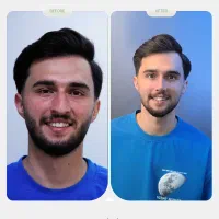 عمل بینی گوشتی و استخوانی / اقساط/شیراز