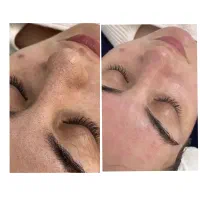 پاکسازی و فشیال تخصصی پوست