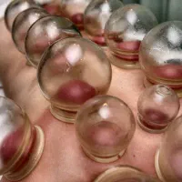 بادکش گرم/پنس بادکش/لیوان بادکش/لیوان حجامت