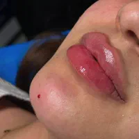 جشنوار بهاره ژل و بوتاکس و شرایط اقساطی