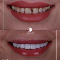 کامپوزیت/لمینت/دندانپزشکی|خدمات آرایشگری و زیبایی|مشهد, کوثر|دیوار